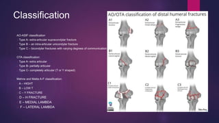 Classification
AO-ASIF classification
Type A- extra-articular supracondylar fracture
Type B – an intra-articular unicondylar fracture
Type C – bicondylar fractures with varying degrees of communication
OTA classification:
Type A- extra articular
Type B- partially articular
Type C- completely articular (T or Y shaped)
Mehne and Matta A-F classification:
A – HIGHT
B – LOW T
C – Y FRACTURE
D – H FRACTURE
E – MEDIAL LAMBDA
F – LATERAL LAMBDA
 