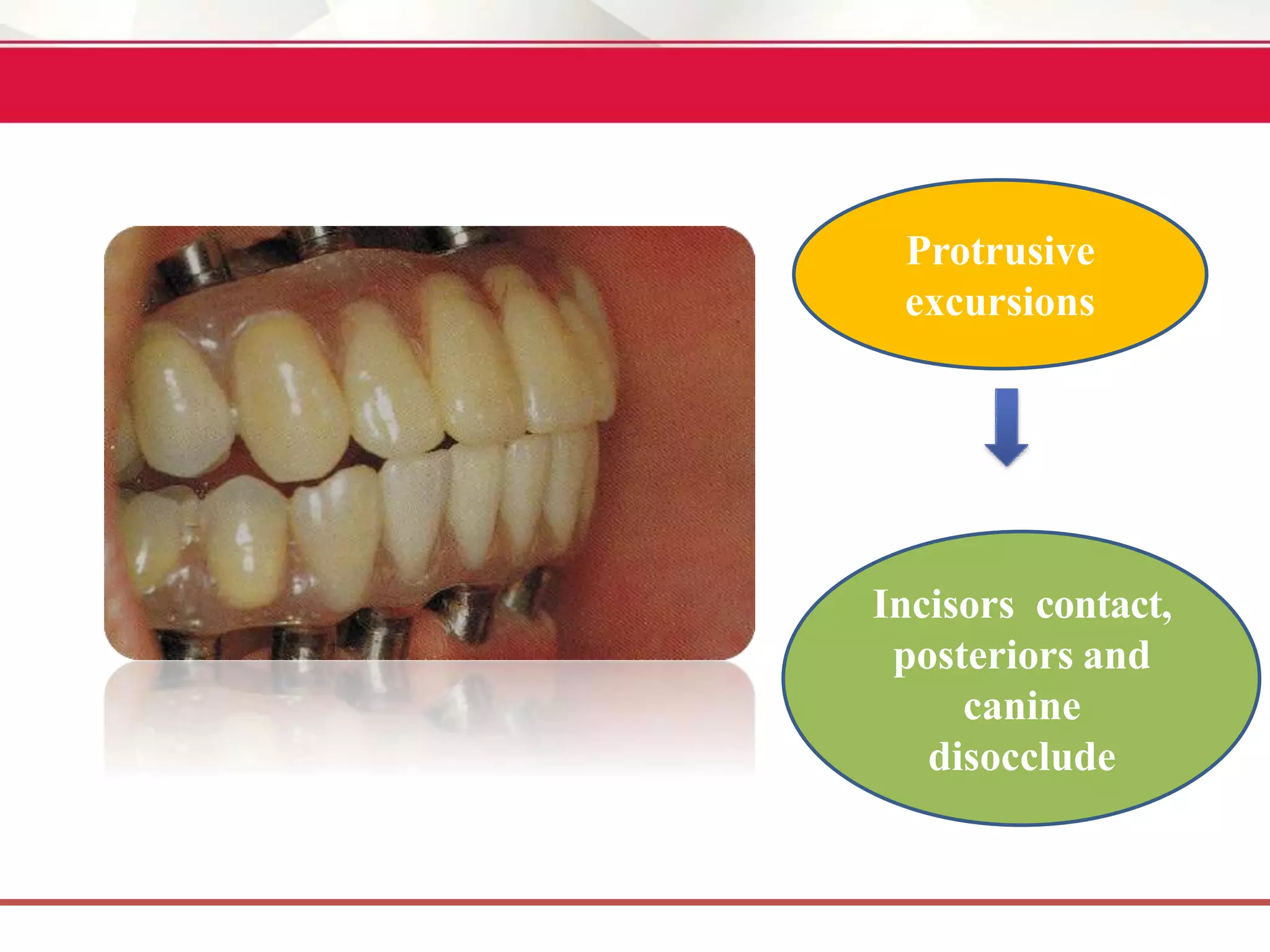 Proclusive IMPLANT OCCLUSION | PPTX