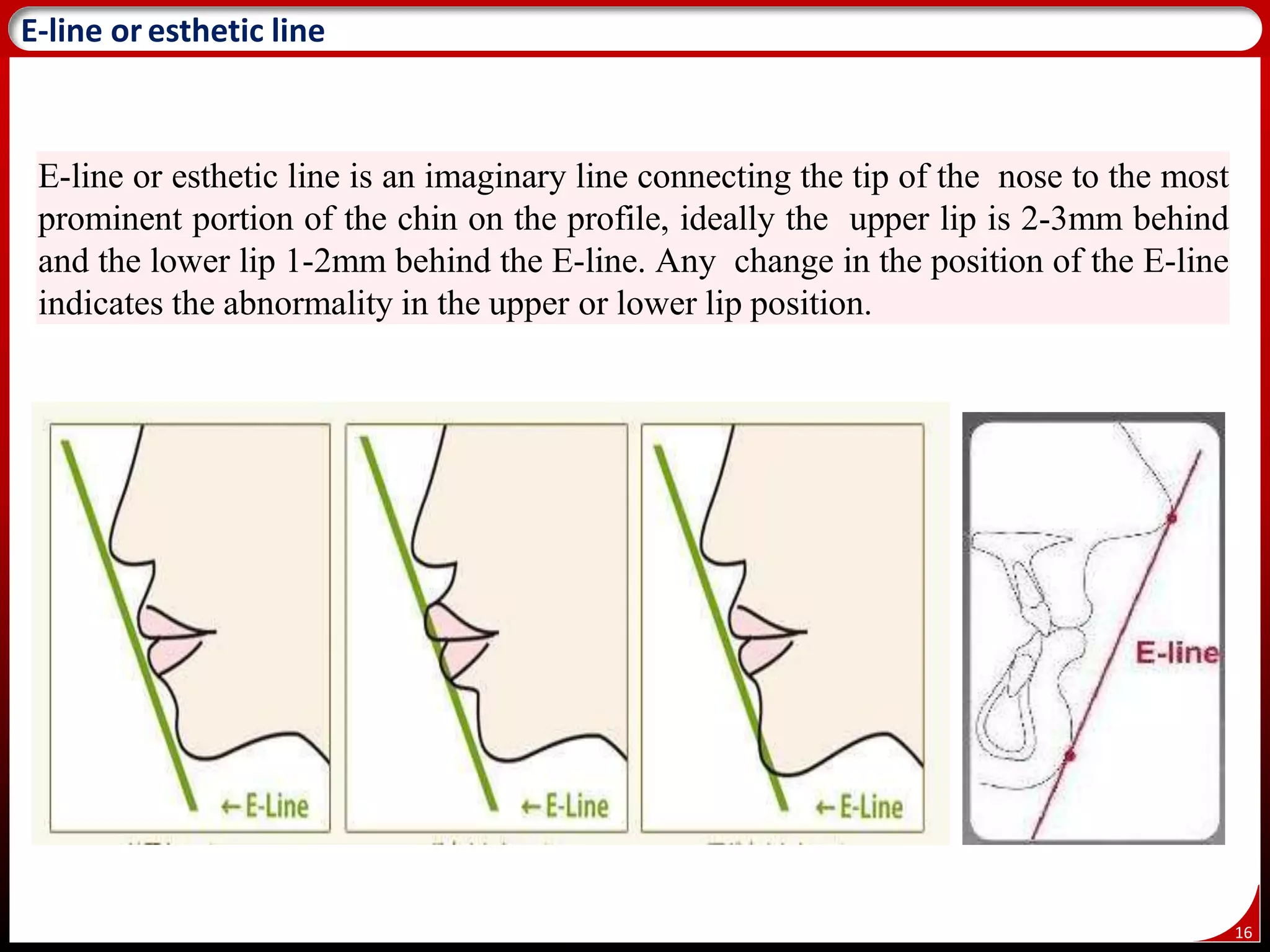 16
E-line or esthetic line is an imaginary line connecting the tip of the nose to the most
prominent portion of the chin on the profile, ideally the upper lip is 2-3mm behind
and the lower lip 1-2mm behind the E-line. Any change in the position of the E-line
indicates the abnormality in the upper or lower lip position.
19
E-line or esthetic line
 