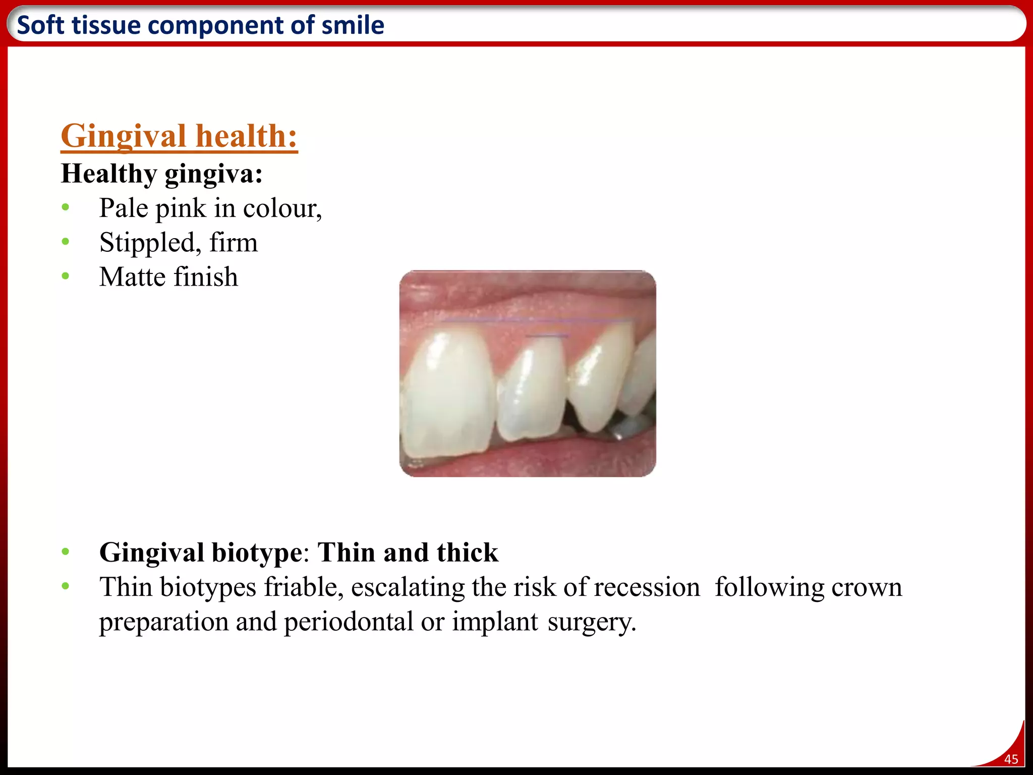 45
Soft tissue component of smile
Gingival health:
Healthy gingiva:
• Pale pink in colour,
• Stippled, firm
• Matte finish
• Gingival biotype: Thin and thick
• Thin biotypes friable, escalating the risk of recession following crown
preparation and periodontal or implant surgery.
 
