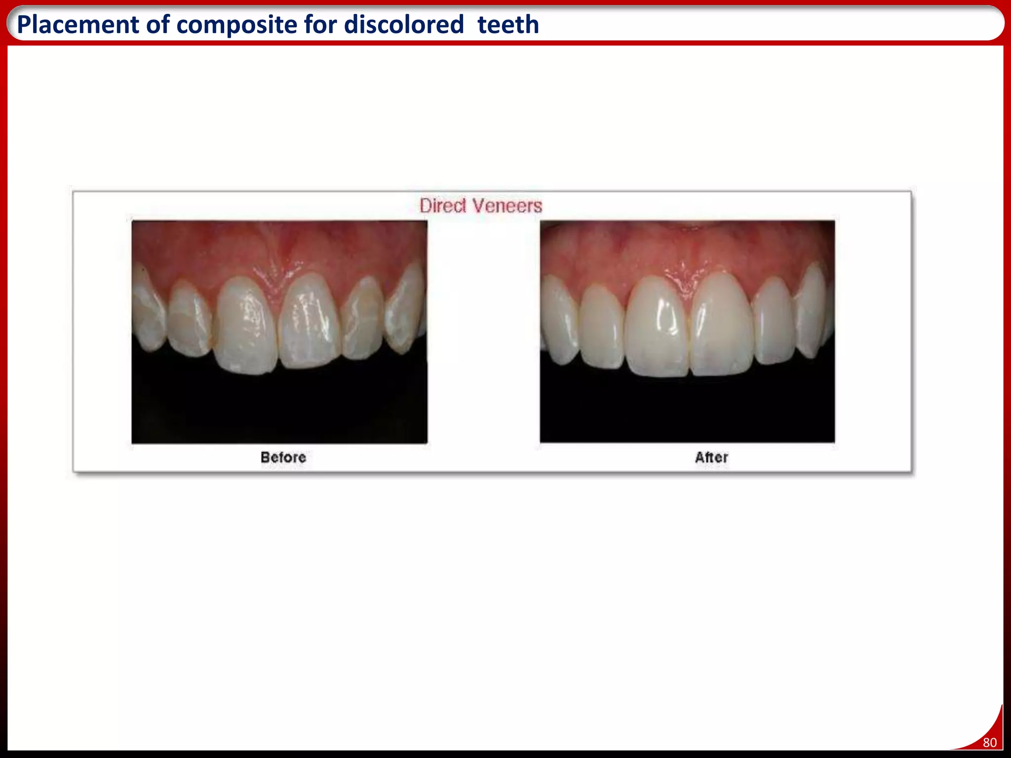 80
86
Placement of composite for discolored teeth
 