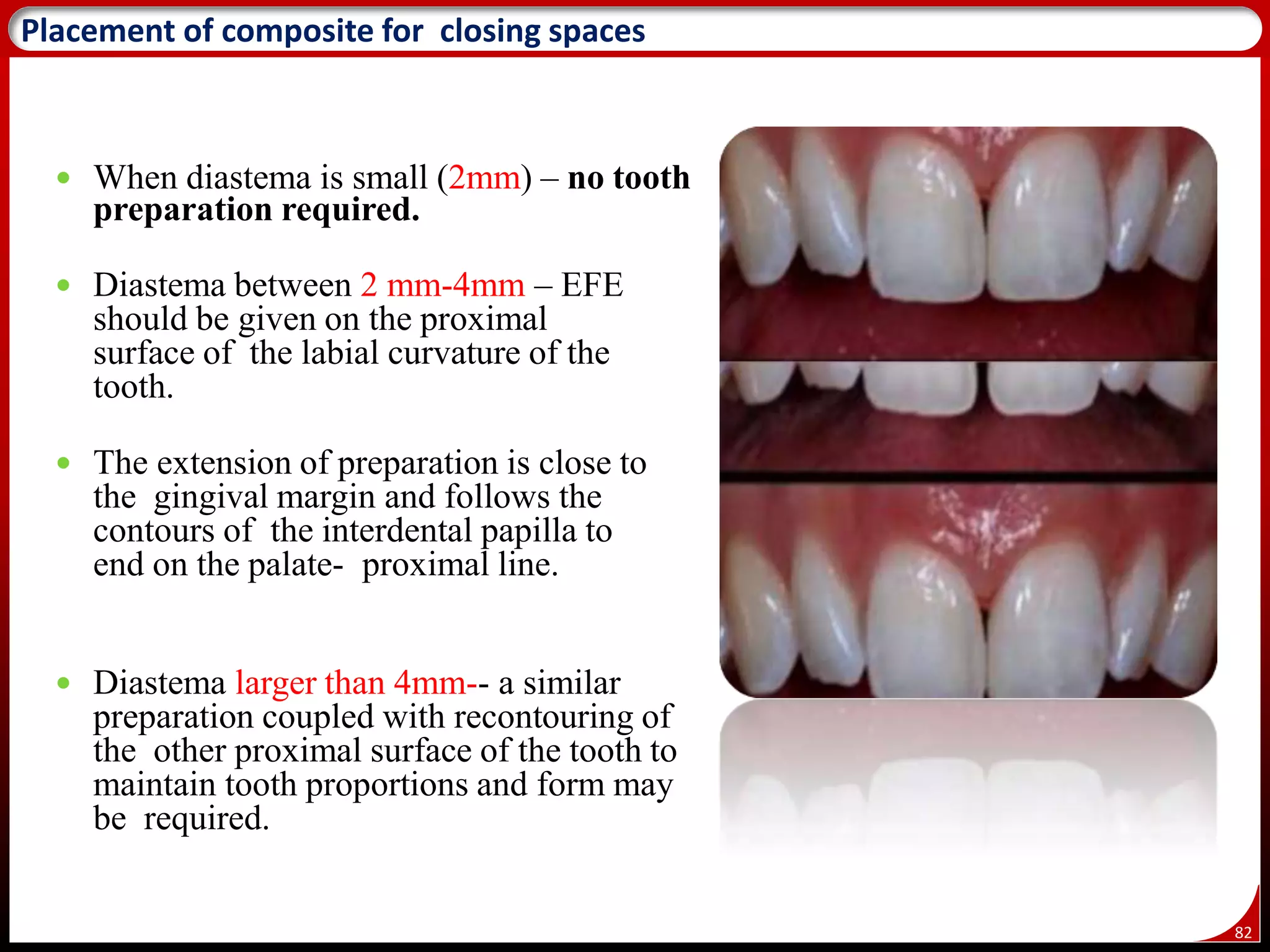 82
 When diastema is small (2mm) – no tooth
preparation required.
 Diastema between 2 mm-4mm – EFE
should be given on the proximal
surface of the labial curvature of the
tooth.
 The extension of preparation is close to
the gingival margin and follows the
contours of the interdental papilla to
end on the palate- proximal line.
 Diastema larger than 4mm-- a similar
preparation coupled with recontouring of
the other proximal surface of the tooth to
maintain tooth proportions and form may
be required.
89
Placement of composite for closing spaces
 