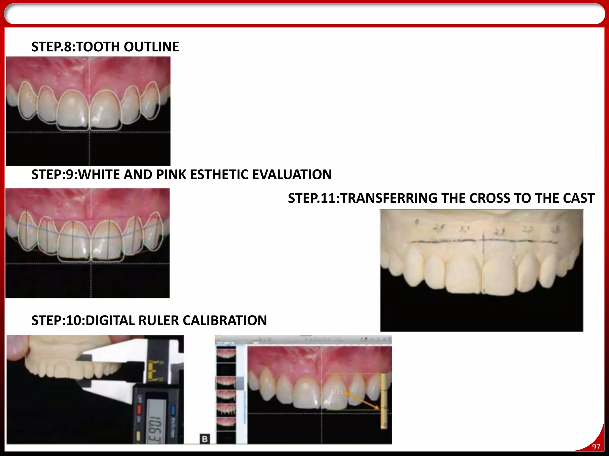 97
STEP.8:TOOTH OUTLINE
STEP:9:WHITE AND PINK ESTHETIC EVALUATION
STEP:10:DIGITAL RULER CALIBRATION
STEP.11:TRANSFERRING THE CROSS TO THE CAST
 