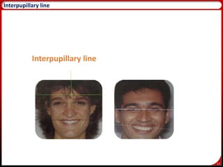 13
16
Interpupillary line
Interpupillary line
 