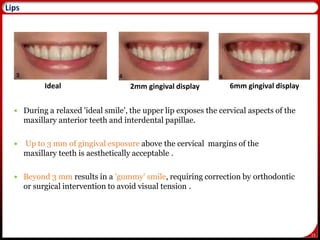 15
 During a relaxed 'ideal smile', the upper lip exposes the cervical aspects of the
maxillary anterior teeth and interdental papillae.
 Up to 3 mm of gingival exposure above the cervical margins of the
maxillary teeth is aesthetically acceptable .
 Beyond 3 mm results in a 'gummy' smile, requiring correction by orthodontic
or surgical intervention to avoid visual tension .
17
Ideal 2mm gingival display 6mm gingival display
Lips
 
