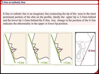 16
E-line or esthetic line is an imaginary line connecting the tip of the nose to the most
prominent portion of the chin on the profile, ideally the upper lip is 2-3mm behind
and the lower lip 1-2mm behind the E-line. Any change in the position of the E-line
indicates the abnormality in the upper or lower lip position.
19
E-line or esthetic line
 