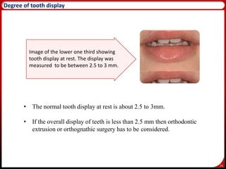 24
Degree of tooth display
Image of the lower one third showing
tooth display at rest. The display was
measured to be between 2.5 to 3 mm.
• The normal tooth display at rest is about 2.5 to 3mm.
• If the overall display of teeth is less than 2.5 mm then orthodontic
extrusion or orthognathic surgery has to be considered.
 