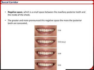 32
Buccal Corridor
• Negative space, which is a small space between the maxillary posterior teeth and
the inside of the cheek.
• The greater and more pronounced this negative space the more the posterior
teeth are concealed..
 