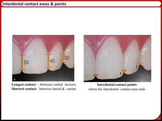 35
Interdental contact areas & points
Longest contact – between central incisors
Shortest contact- between lateral & canine
Interdental contact points
where the interdental contact area ends
 