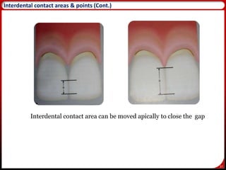 37
Interdental contact area can be moved apically to close the gap
37
Interdental contact areas & points (Cont.)
 