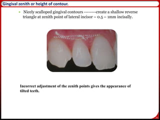 39
 Nicely scalloped gingival contours --------create a shallow reverse
triangle at zenith point of lateral incisor – 0.5 – 1mm incisally.
39
Incorrect adjustment of the zenith points gives the appearance of
tilted teeth.
Gingival zenith or height of contour.
 