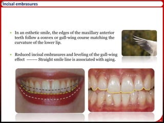 40
Incisal embrasures
 In an esthetic smile, the edges of the maxillary anterior
teeth follow a convex or gull-wing course matching the
curvature of the lower lip.
 Reduced incisal embrasures and leveling of the gull-wing
effect ------- Straight smile line is associated with aging.
 