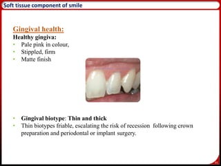 45
Soft tissue component of smile
Gingival health:
Healthy gingiva:
• Pale pink in colour,
• Stippled, firm
• Matte finish
• Gingival biotype: Thin and thick
• Thin biotypes friable, escalating the risk of recession following crown
preparation and periodontal or implant surgery.
 
