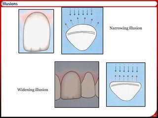 63
Narrowing illusion
Widening illusion
64
Illusions
 
