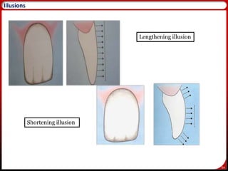 64
Lengthening illusion
Shortening illusion
65
Illusions
 