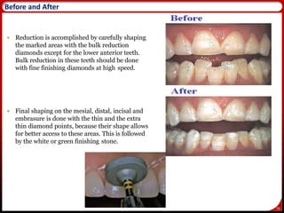 70
 Reduction is accomplished by carefully shaping
the marked areas with the bulk reduction
diamonds except for the lower anterior teeth.
Bulk reduction in these teeth should be done
with fine finishing diamonds at high speed.
 Final shaping on the mesial, distal, incisal and
embrasure is done with the thin and the extra
thin diamond points, because their shape allows
for better access to these areas. This is followed
by the white or green finishing stone.
71
Before and After
 