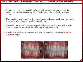 76
 Remove as much as possible of the tooth structures that overlaps the
adjacent tooth by contouring the labial aspect of the labially malposed
tooth.
 This straightens the portion that overlaps the adjacent tooth and makes the
long axis of teeth more parallel to each other.
 The effective use of opaque composites in areas having no tooth or thin
palatal structure,improves the blending of the restoration.
 The incisal embrasure between the teeth is reopened to at least 0.25 to
0.50mm length.
EFE & PLACEMENT OF COMPOSITE FOR MAL-ALIGNED CENTRAL INCISORS
 