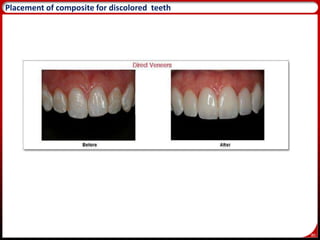 80
86
Placement of composite for discolored teeth
 