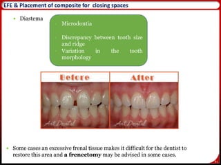 81
 Diastema
EFE & Placement of composite for closing spaces
• Microdontia
• Discrepancy between tooth size
and ridge
• Variation in the tooth
morphology
 Some cases an excessive frenal tissue makes it difficult for the dentist to
restore this area and a frenectomy may be advised in some cases.
 