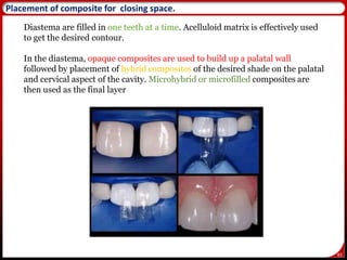 83
Placement of composite for closing space.
Diastema are filled in one teeth at a time. Acelluloid matrix is effectively used
to get the desired contour.
In the diastema, opaque composites are used to build up a palatal wall
followed by placement of hybrid composites of the desired shade on the palatal
and cervical aspect of the cavity. Microhybrid or microfilled composites are
then used as the final layer
 