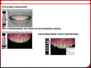 96
STEP:6:SMILE SIMULATION
STEP 7:TRANSFERRING THE CROSS TO THE INTRAORAL IMAGES
STEP:8:MEASURING TOOTH PROPORTIONS
 