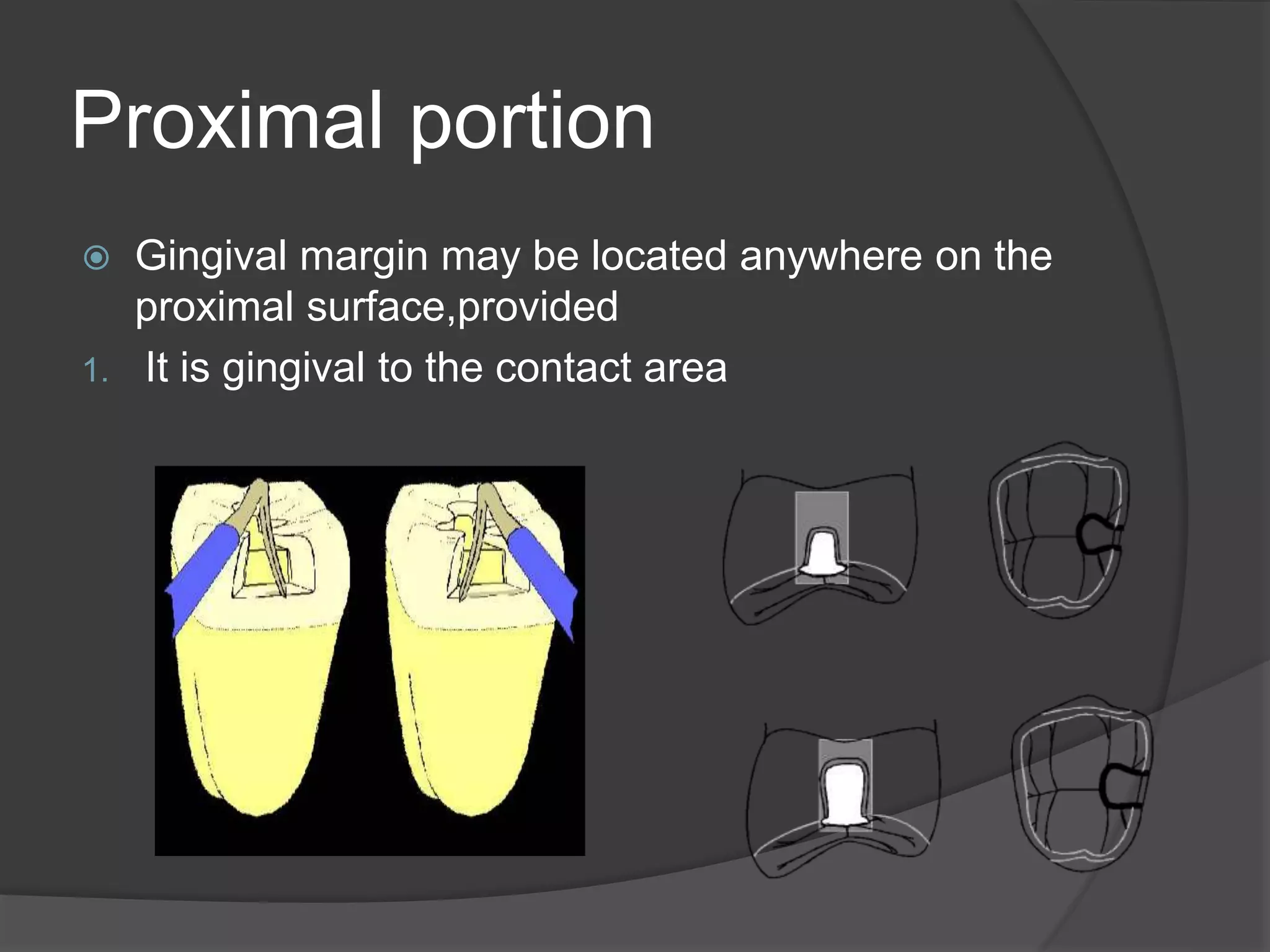 Proximal portion 
 Gingival margin may be located anywhere on the 
proximal surface,provided 
1. It is gingival to the contact area 
 