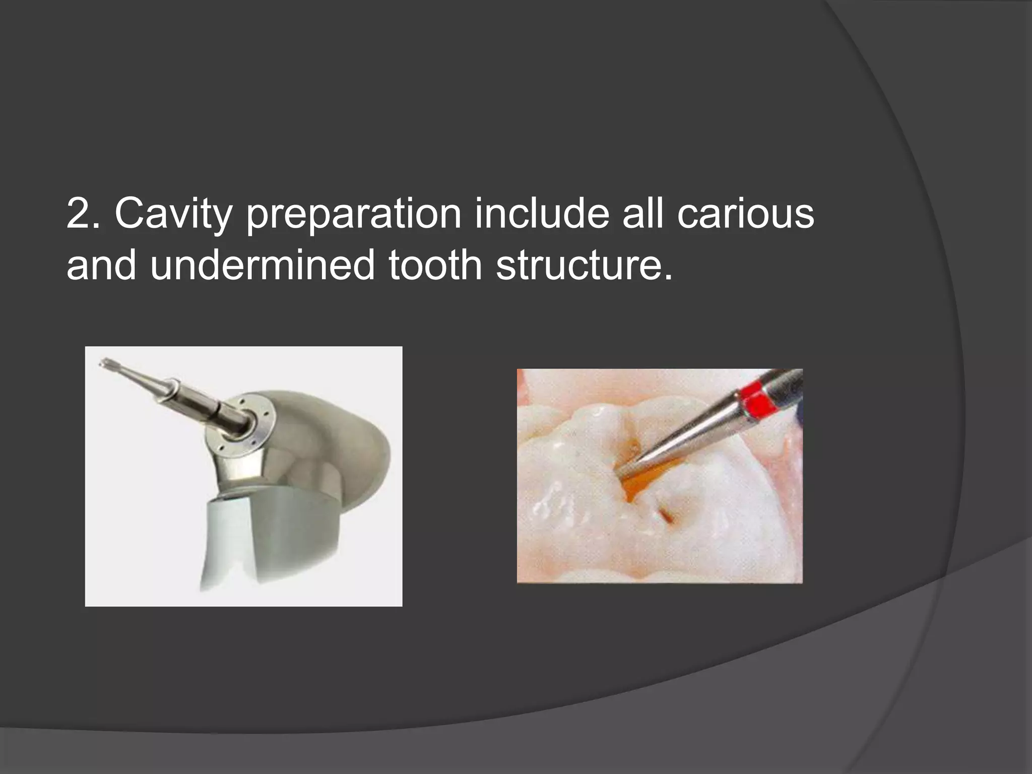 2. Cavity preparation include all carious 
and undermined tooth structure. 
 