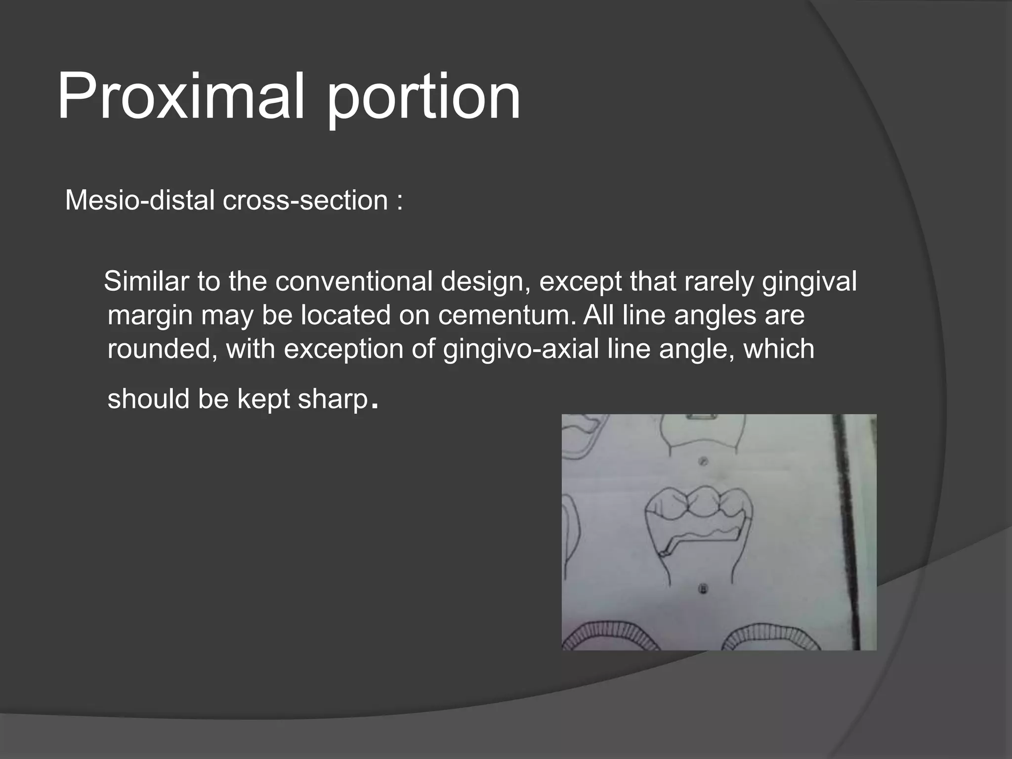 Proximal portion 
Mesio-distal cross-section : 
Similar to the conventional design, except that rarely gingival 
margin may be located on cementum. All line angles are 
rounded, with exception of gingivo-axial line angle, which 
should be kept sharp. 
 