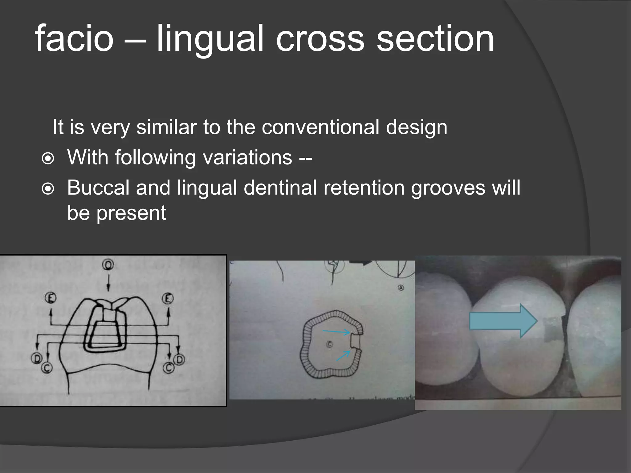 facio – lingual cross section 
It is very similar to the conventional design 
 With following variations -- 
 Buccal and lingual dentinal retention grooves will 
be present 
 