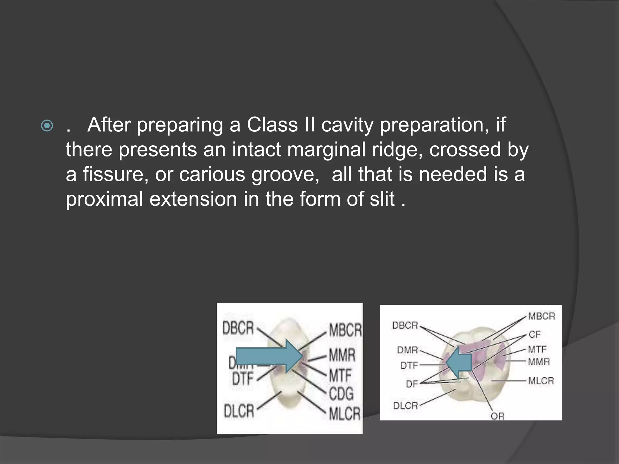  . After preparing a Class II cavity preparation, if 
there presents an intact marginal ridge, crossed by 
a fissure, or carious groove, all that is needed is a 
proximal extension in the form of slit . 
 