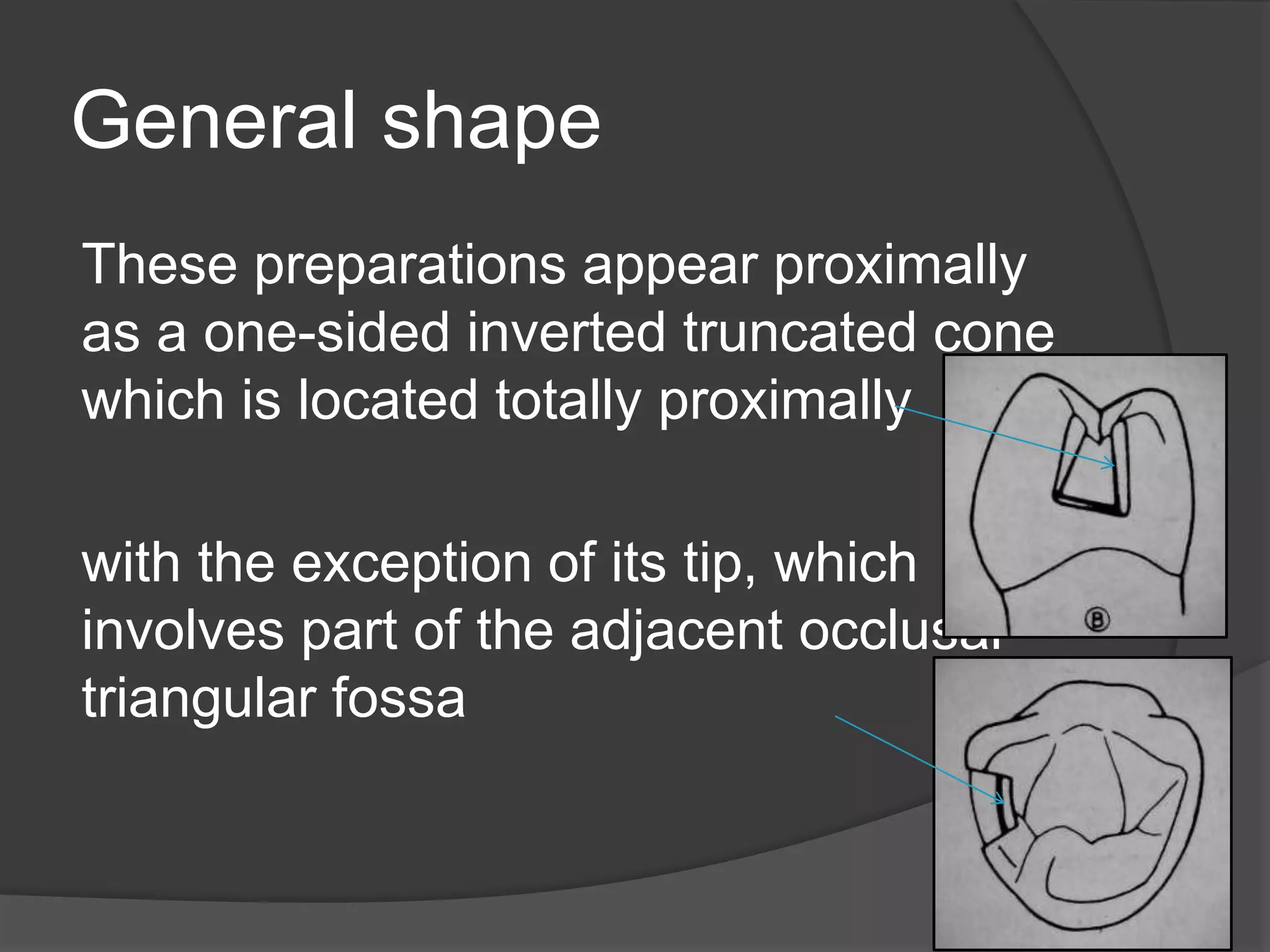 General shape 
These preparations appear proximally 
as a one-sided inverted truncated cone 
which is located totally proximally 
with the exception of its tip, which 
involves part of the adjacent occlusal 
triangular fossa 
 