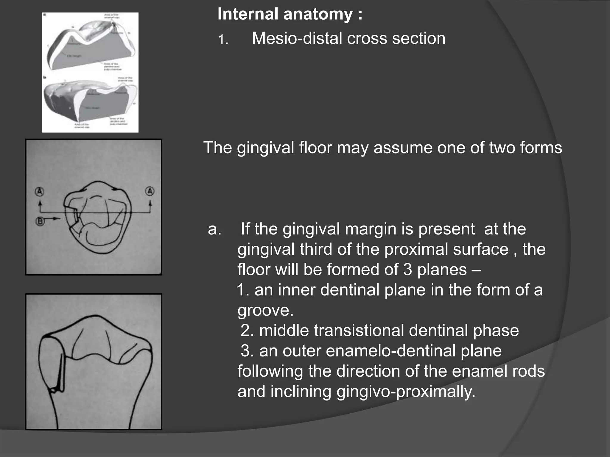 Internal anatomy : 
1. Mesio-distal cross section 
The gingival floor may assume one of two forms 
a. If the gingival margin is present at the 
gingival third of the proximal surface , the 
floor will be formed of 3 planes – 
1. an inner dentinal plane in the form of a 
groove. 
2. middle transistional dentinal phase 
3. an outer enamelo-dentinal plane 
following the direction of the enamel rods 
and inclining gingivo-proximally. 
 