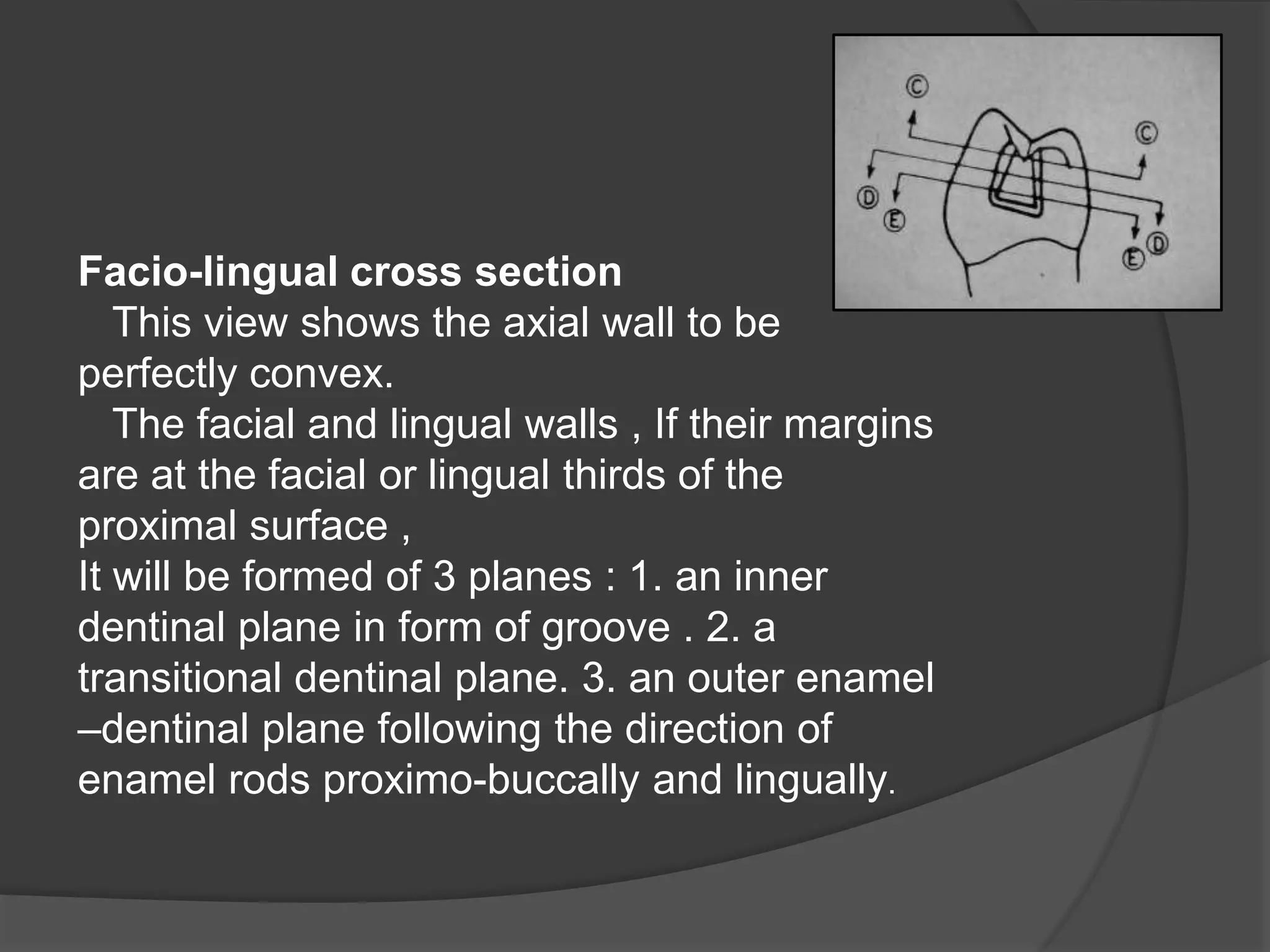 Facio-lingual cross section 
This view shows the axial wall to be 
perfectly convex. 
The facial and lingual walls , If their margins 
are at the facial or lingual thirds of the 
proximal surface , 
It will be formed of 3 planes : 1. an inner 
dentinal plane in form of groove . 2. a 
transitional dentinal plane. 3. an outer enamel 
–dentinal plane following the direction of 
enamel rods proximo-buccally and lingually. 
 