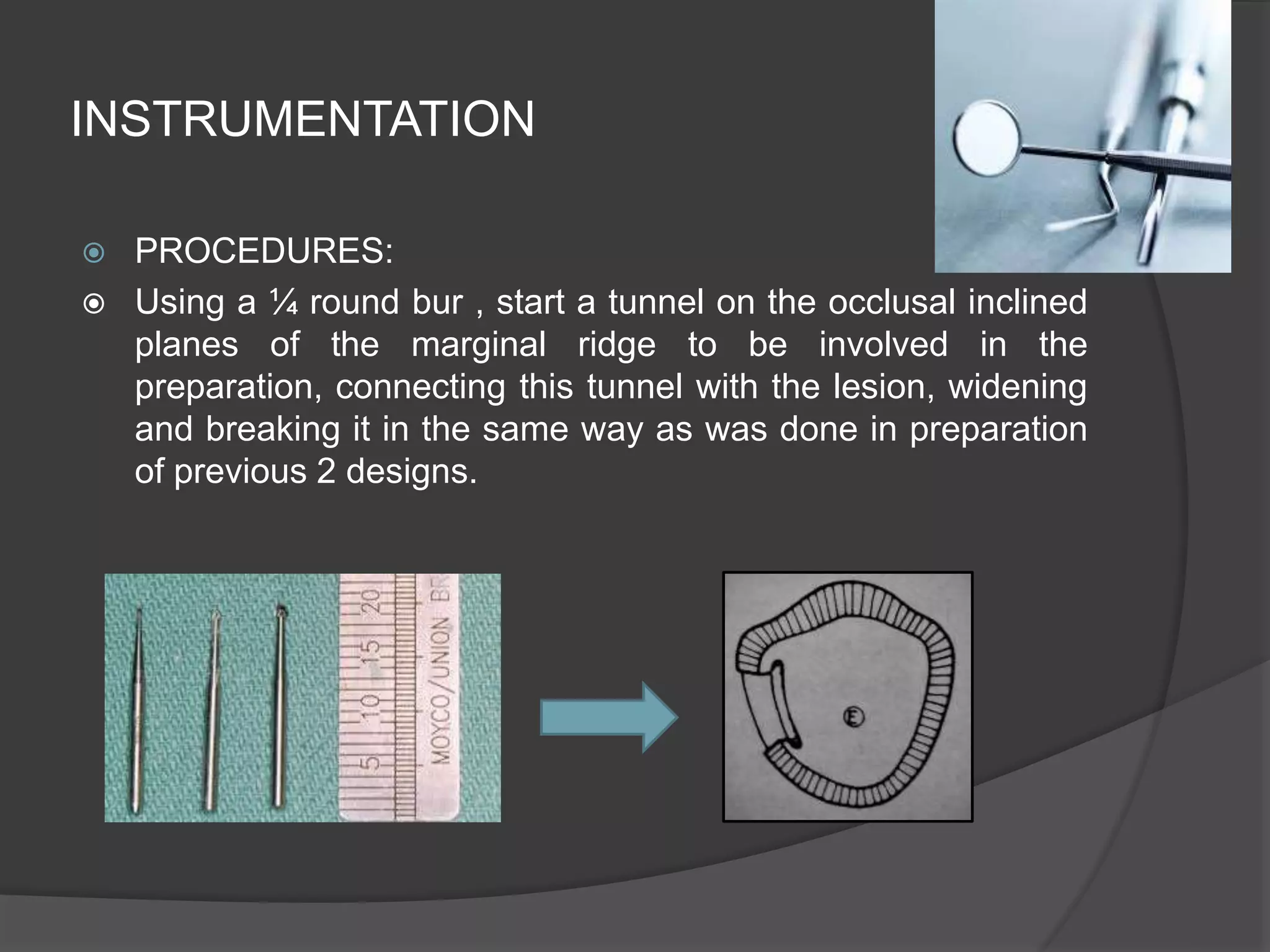 INSTRUMENTATION 
 PROCEDURES: 
 Using a ¼ round bur , start a tunnel on the occlusal inclined 
planes of the marginal ridge to be involved in the 
preparation, connecting this tunnel with the lesion, widening 
and breaking it in the same way as was done in preparation 
of previous 2 designs. 
 