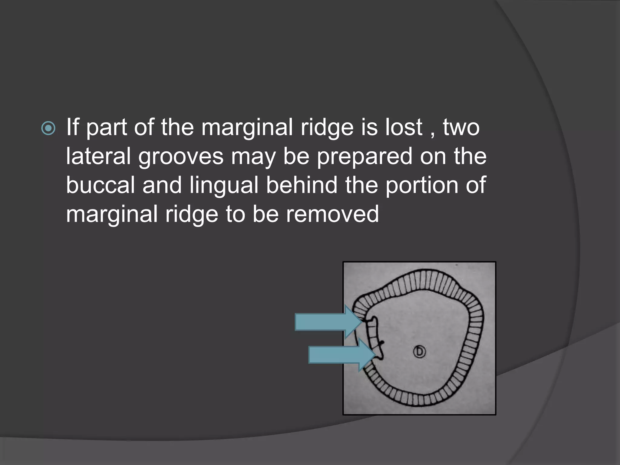  If part of the marginal ridge is lost , two 
lateral grooves may be prepared on the 
buccal and lingual behind the portion of 
marginal ridge to be removed 
 