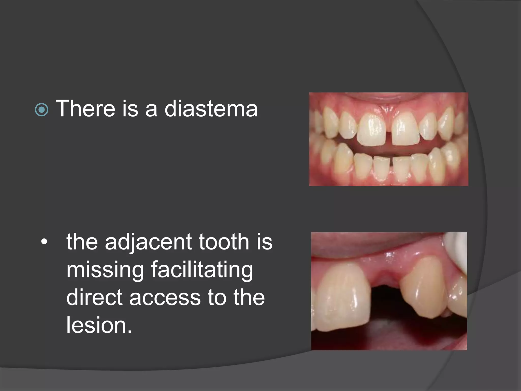  There is a diastema 
• the adjacent tooth is 
missing facilitating 
direct access to the 
lesion. 
 