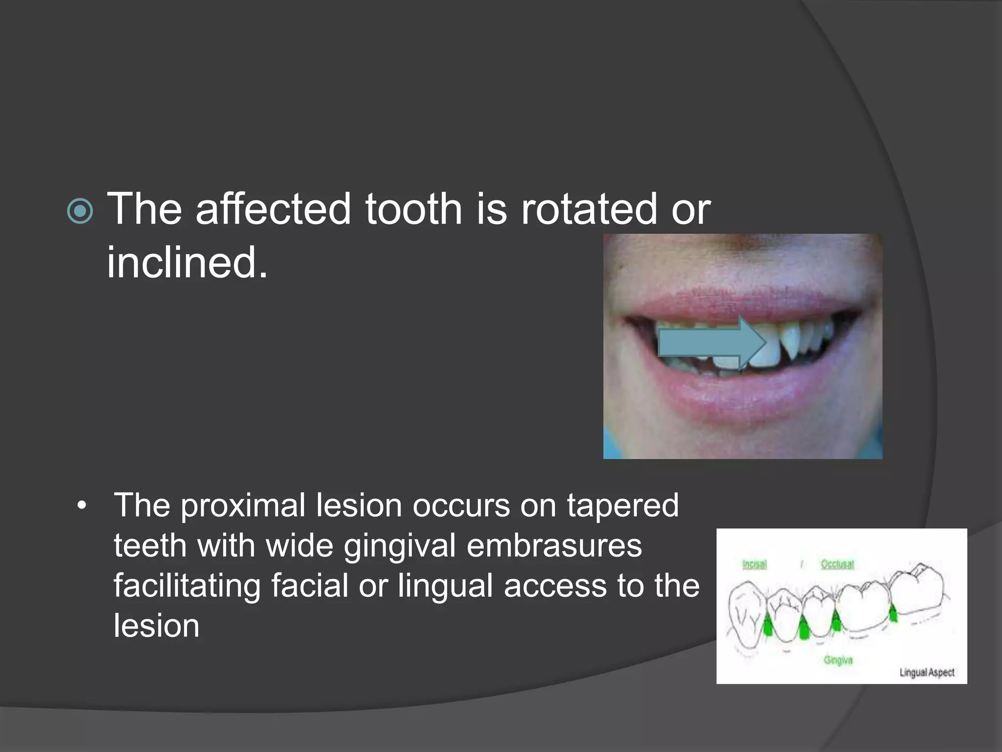  The affected tooth is rotated or 
inclined. 
• The proximal lesion occurs on tapered 
teeth with wide gingival embrasures 
facilitating facial or lingual access to the 
lesion 
 