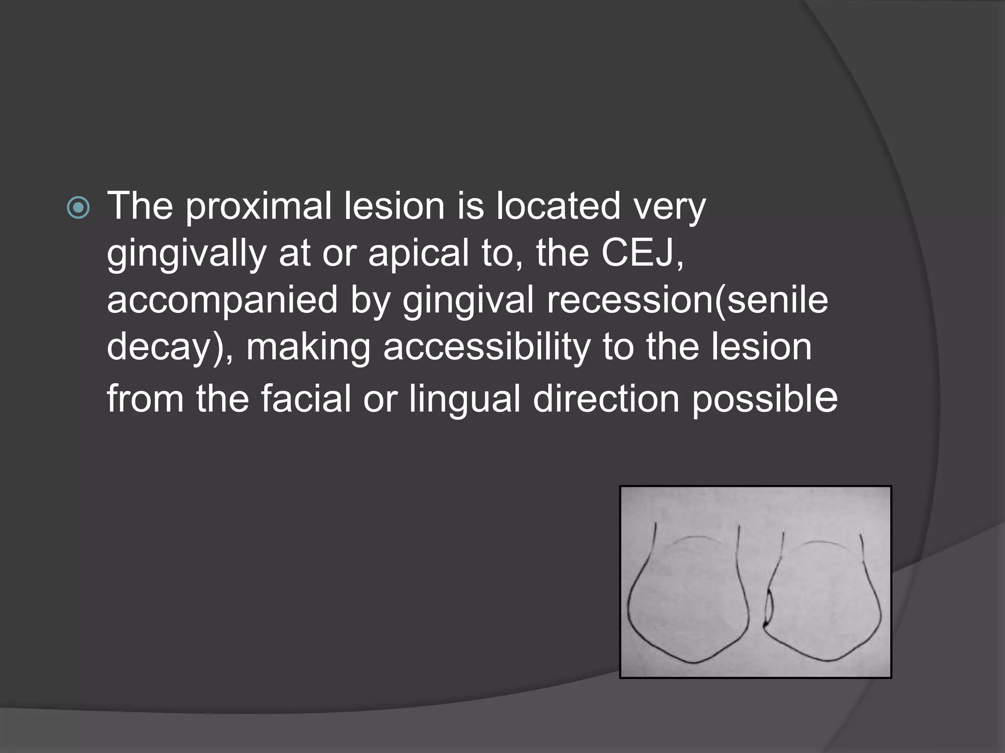  The proximal lesion is located very 
gingivally at or apical to, the CEJ, 
accompanied by gingival recession(senile 
decay), making accessibility to the lesion 
from the facial or lingual direction possible 
 