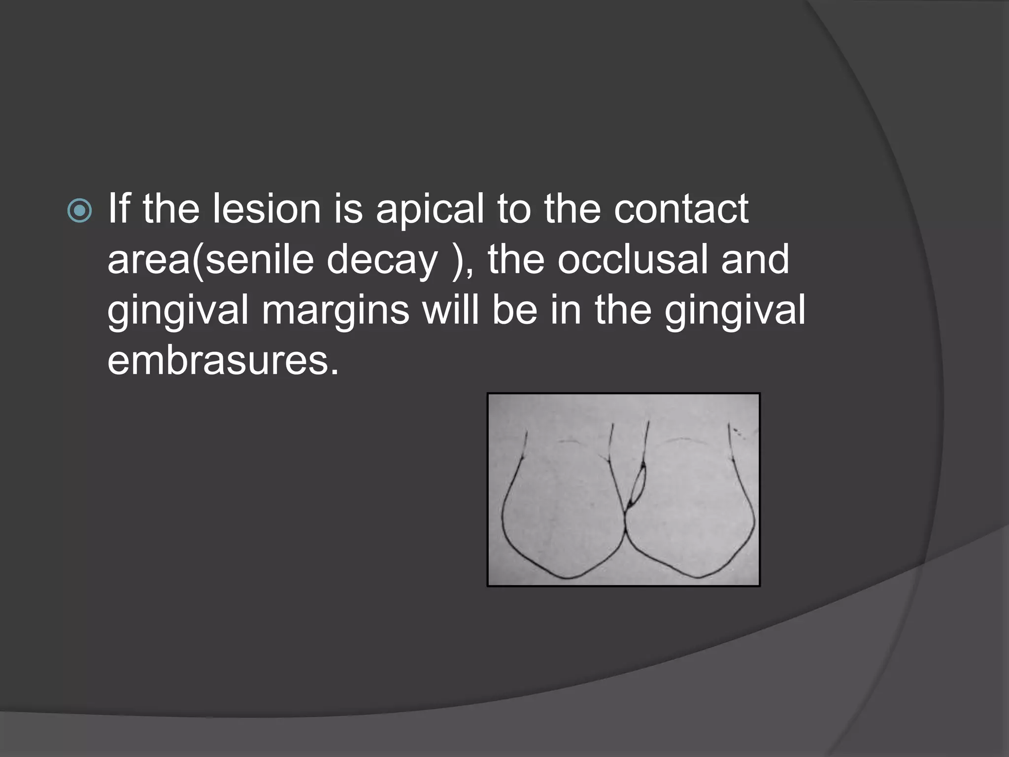  If the lesion is apical to the contact 
area(senile decay ), the occlusal and 
gingival margins will be in the gingival 
embrasures. 
 