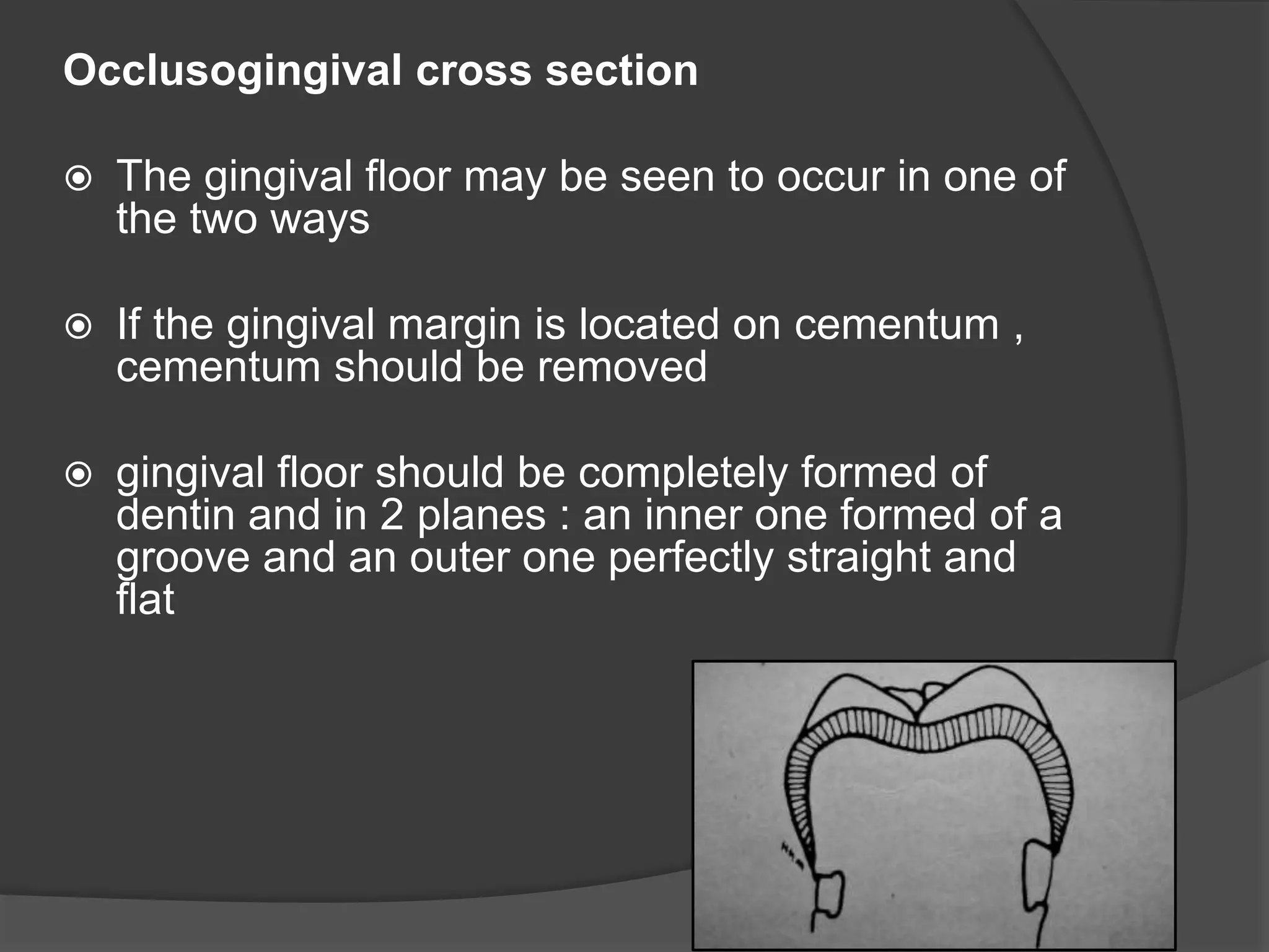 Occlusogingival cross section 
 The gingival floor may be seen to occur in one of 
the two ways 
 If the gingival margin is located on cementum , 
cementum should be removed 
 gingival floor should be completely formed of 
dentin and in 2 planes : an inner one formed of a 
groove and an outer one perfectly straight and 
flat 
 