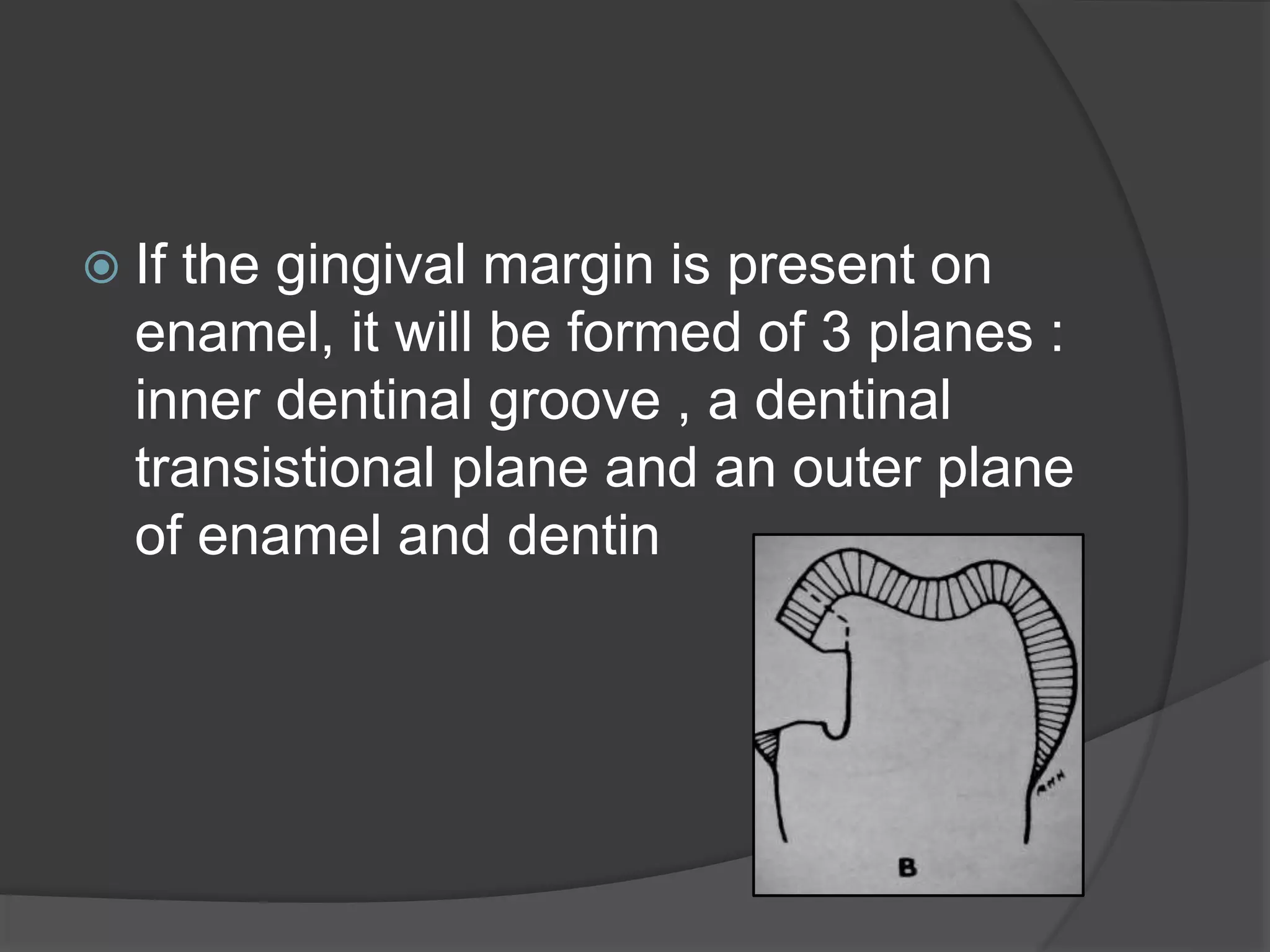  If the gingival margin is present on 
enamel, it will be formed of 3 planes : 
inner dentinal groove , a dentinal 
transistional plane and an outer plane 
of enamel and dentin 
 