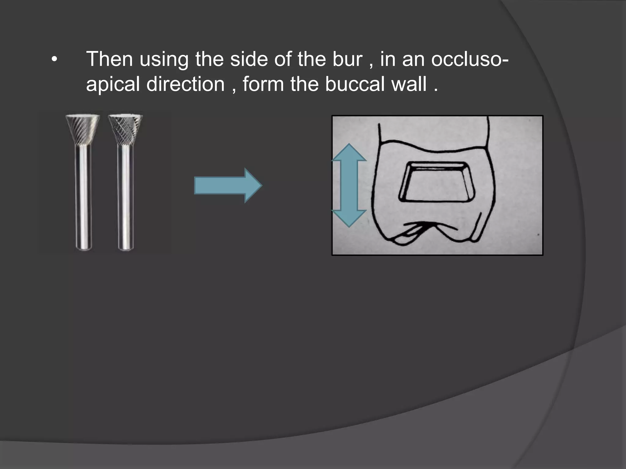 • Then using the side of the bur , in an occluso-apical 
direction , form the buccal wall . 
 
