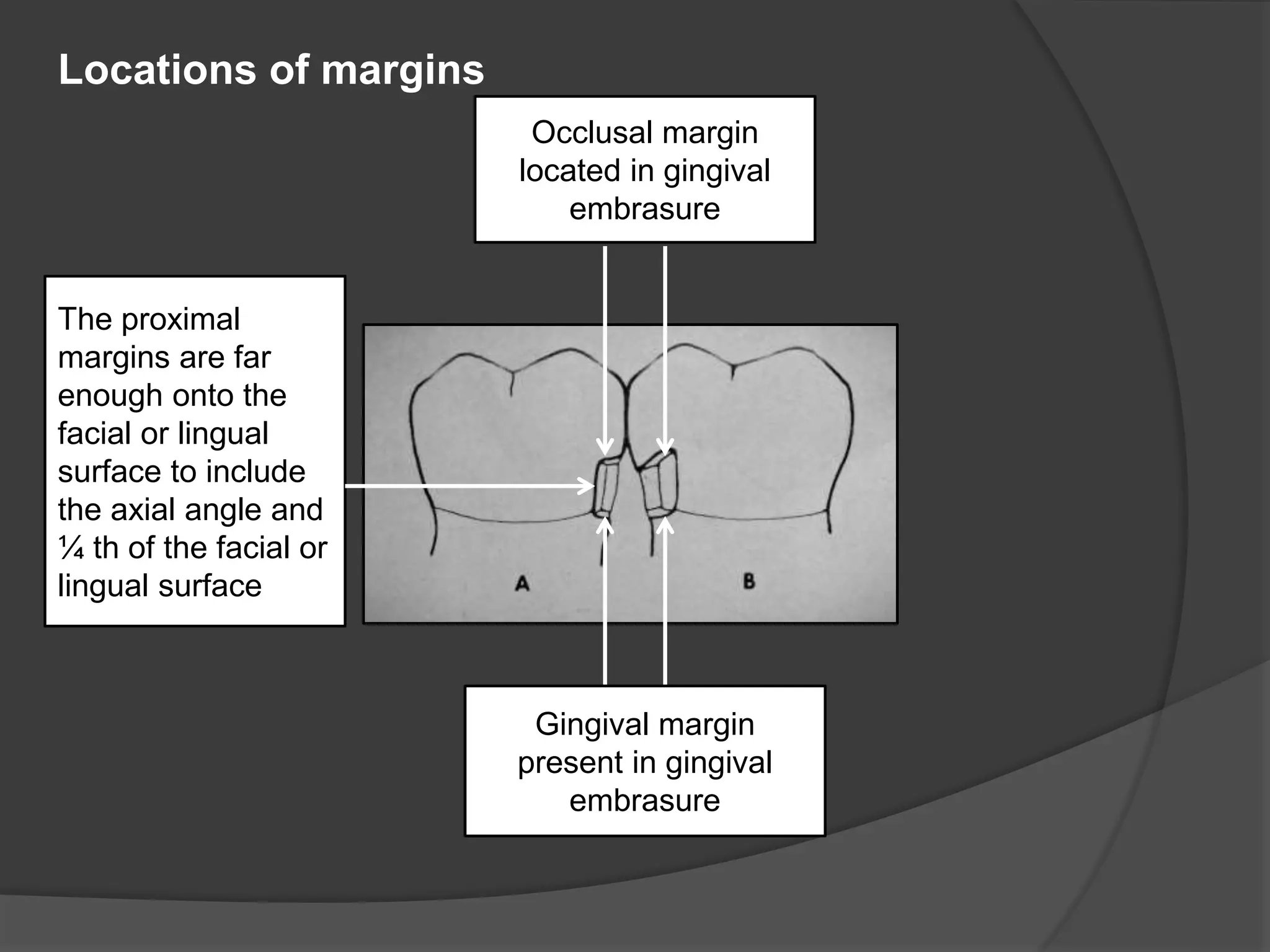 Occlusal margin 
located in gingival 
embrasure 
Gingival margin 
present in gingival 
embrasure 
Locations of margins 
The proximal 
margins are far 
enough onto the 
facial or lingual 
surface to include 
the axial angle and 
¼ th of the facial or 
lingual surface. 
 