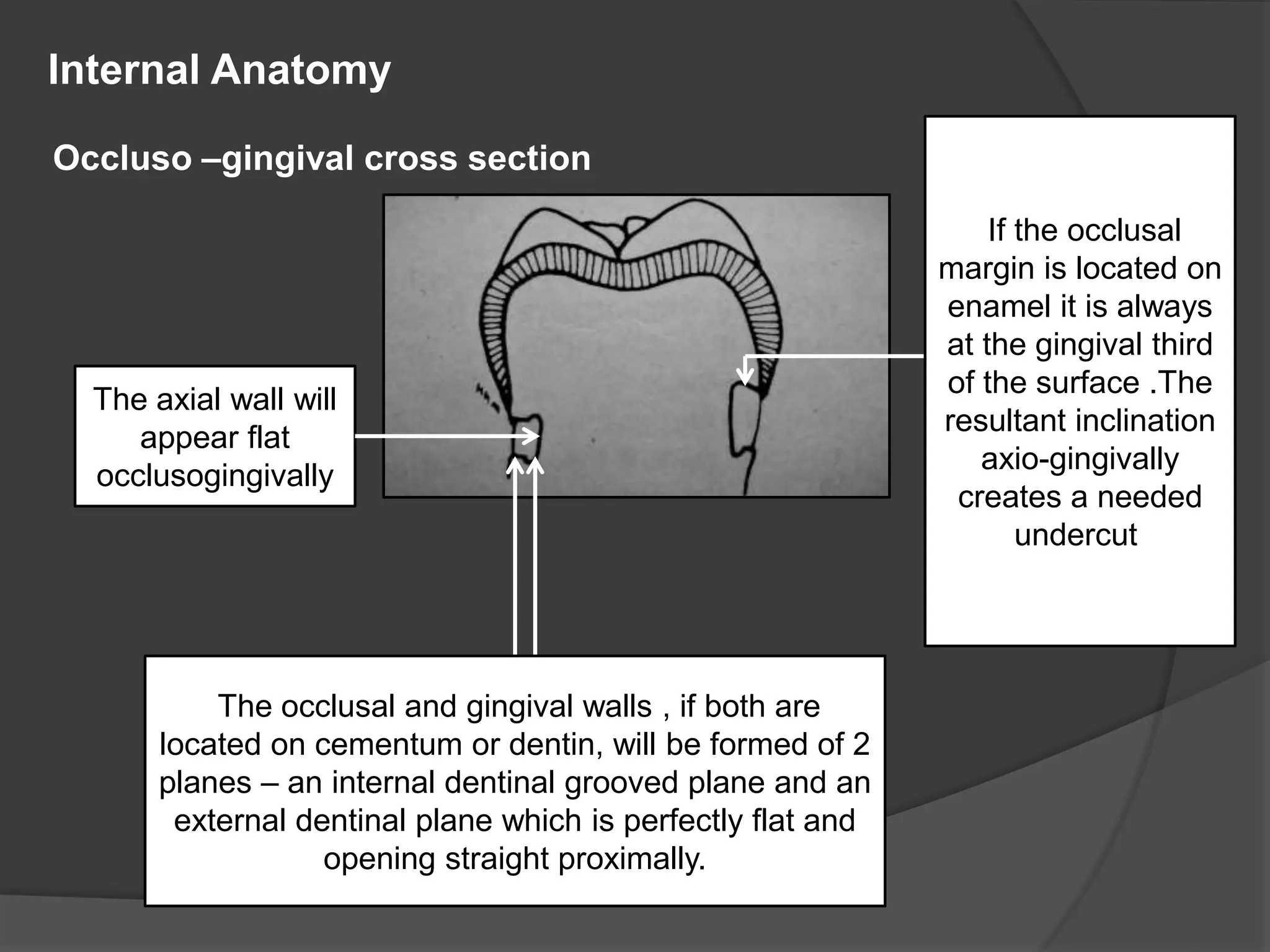 Internal Anatomy 
Occluso –gingival cross section 
The axial wall will 
appear flat 
occlusogingivally 
The occlusal and gingival walls , if both are 
located on cementum or dentin, will be formed of 2 
planes – an internal dentinal grooved plane and an 
external dentinal plane which is perfectly flat and 
opening straight proximally. 
If the occlusal 
margin is located on 
enamel it is always 
at the gingival third 
of the surface .The 
resultant inclination 
axio-gingivally 
creates a needed 
undercut. 
 