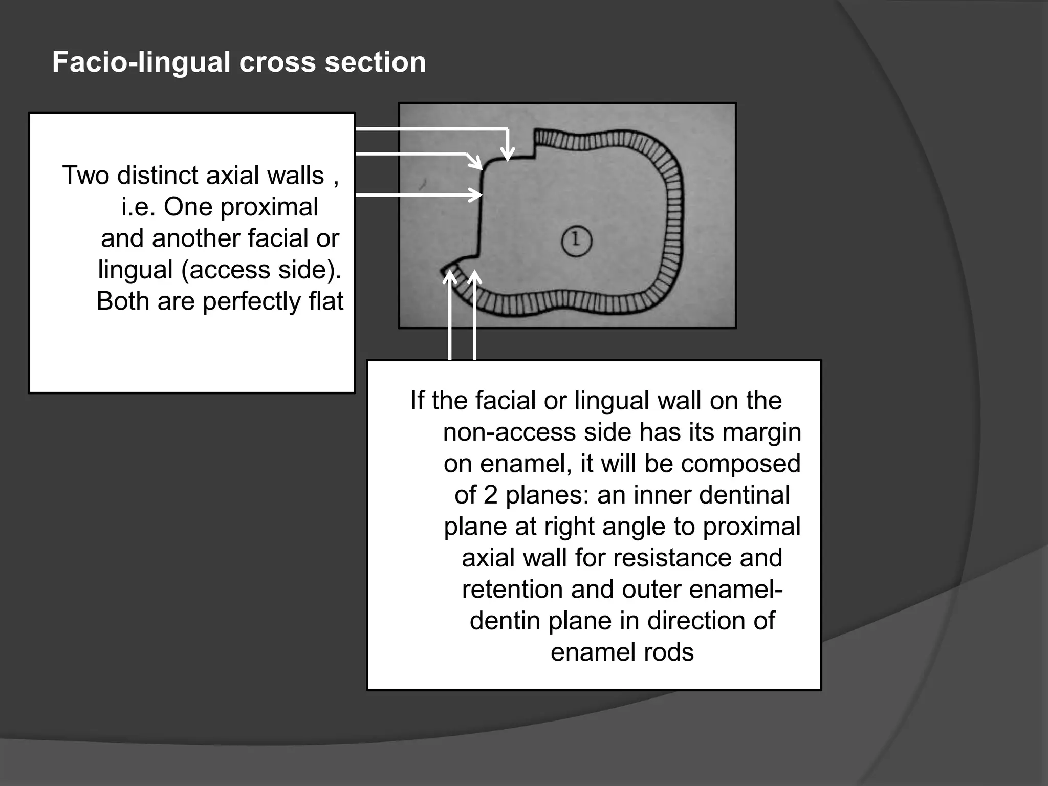 Two distinct axial walls , 
i.e. One proximal 
and another facial or 
lingual (access side). 
Both are perfectly flat 
. 
If the facial or lingual wall on the 
non-access side has its margin 
on enamel, it will be composed 
of 2 planes: an inner dentinal 
plane at right angle to proximal 
axial wall for resistance and 
retention and outer enamel-dentin 
plane in direction of 
enamel rods 
Facio-lingual cross section 
 
