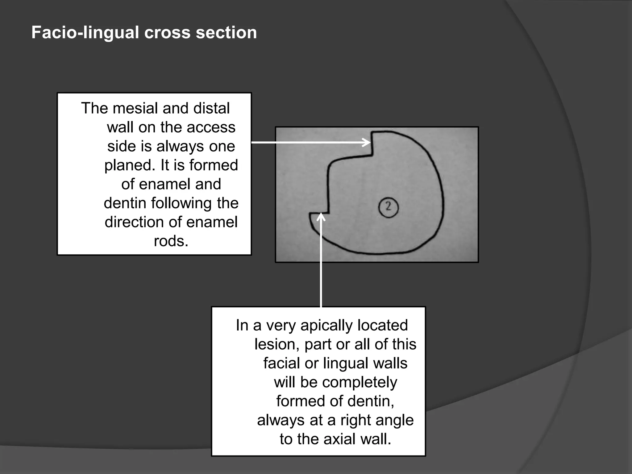 Facio-lingual cross section 
In a very apically located 
lesion, part or all of this 
facial or lingual walls 
will be completely 
formed of dentin, 
always at a right angle 
to the axial wall. 
The mesial and distal 
wall on the access 
side is always one 
planed. It is formed 
of enamel and 
dentin following the 
direction of enamel 
rods. 
 