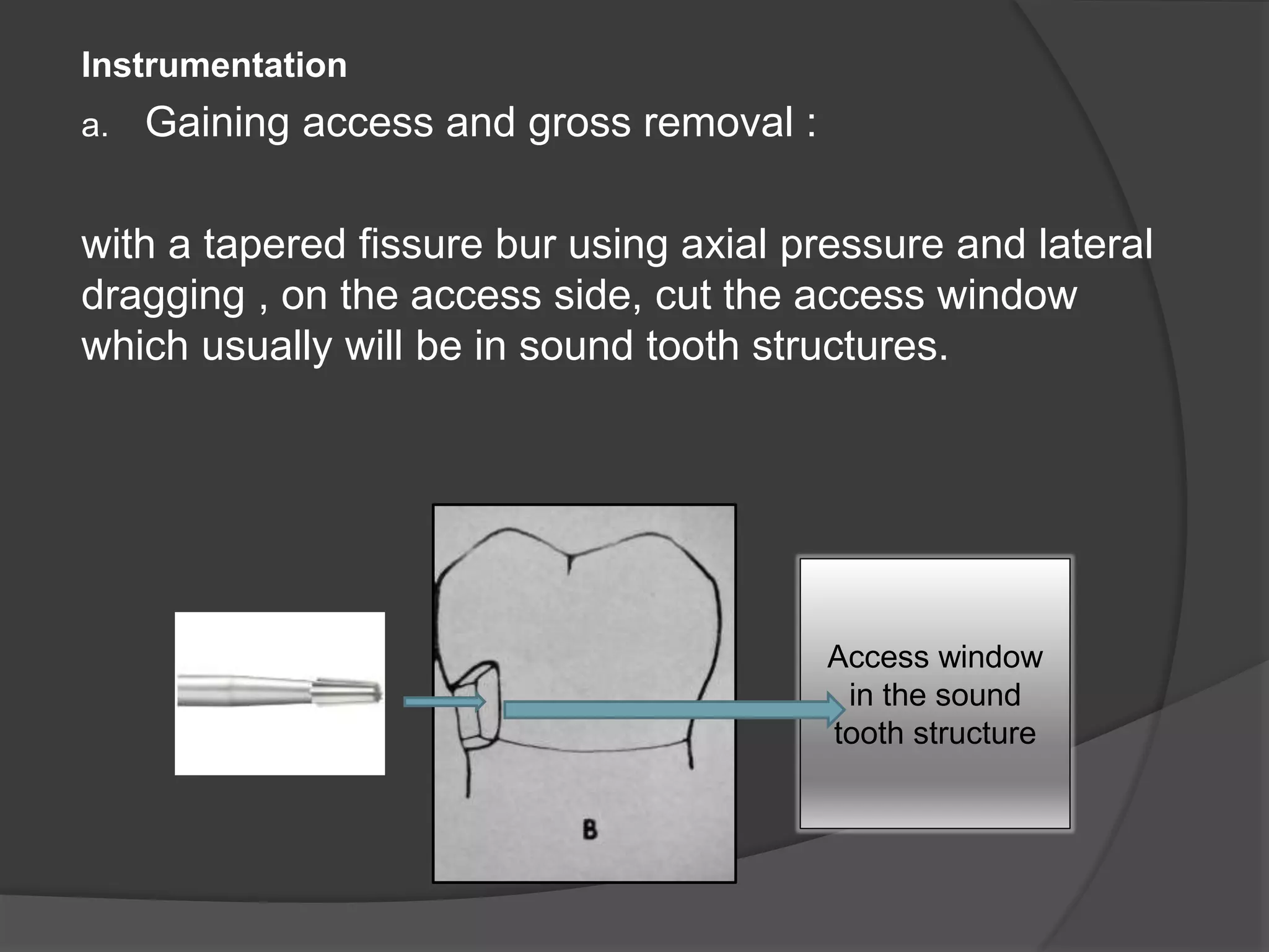 Instrumentation 
a. Gaining access and gross removal : 
with a tapered fissure bur using axial pressure and lateral 
dragging , on the access side, cut the access window 
which usually will be in sound tooth structures. 
Access window 
in the sound 
tooth structure 
 