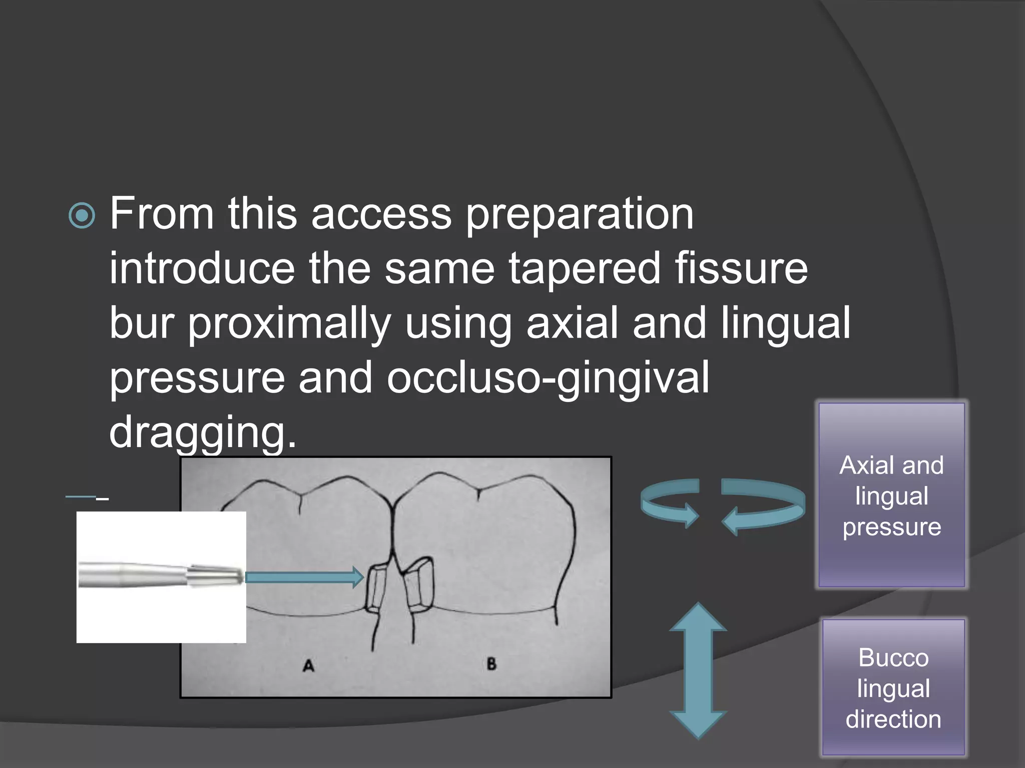  From this access preparation 
introduce the same tapered fissure 
bur proximally using axial and lingual 
pressure and occluso-gingival 
dragging. 
Axial and 
lingual 
pressure 
Bucco 
lingual 
direction 
 