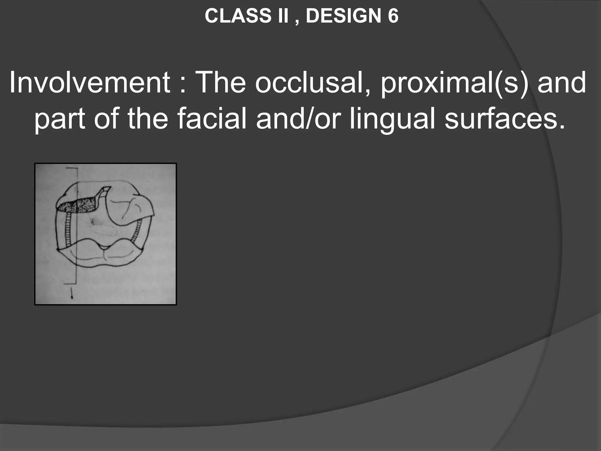 CLASS II , DESIGN 6 
Involvement : The occlusal, proximal(s) and 
part of the facial and/or lingual surfaces. 
 