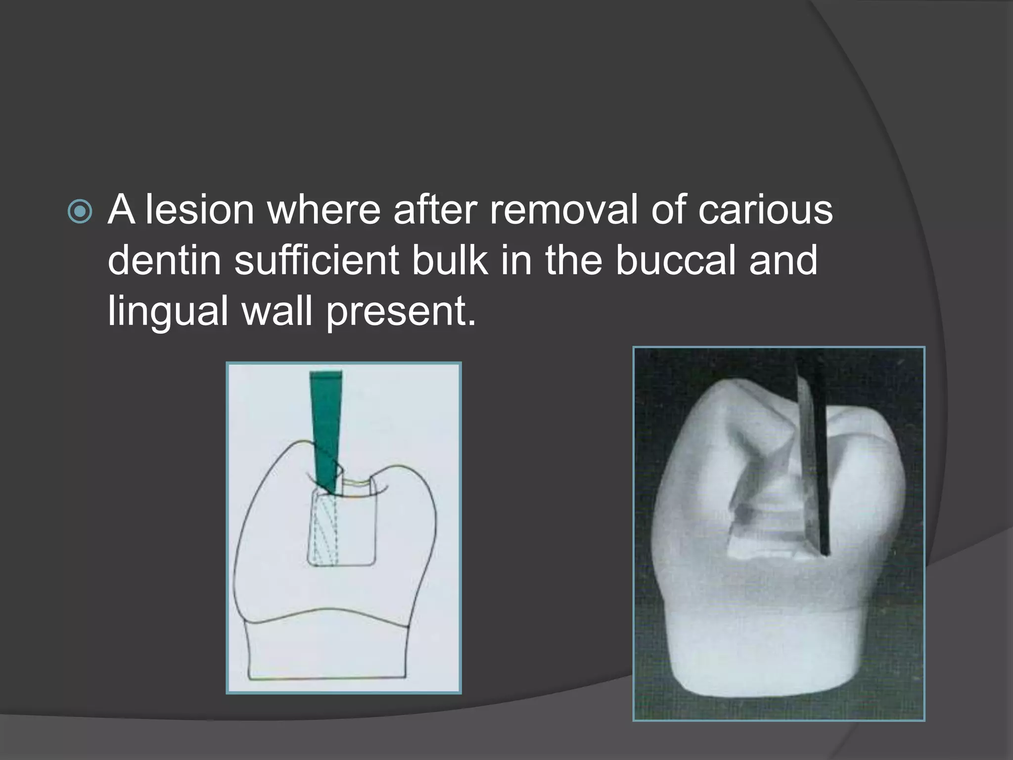  A lesion where after removal of carious 
dentin sufficient bulk in the buccal and 
lingual wall present. 
 